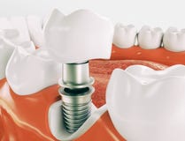 Implante dental - série 2 de 3 - rendição 3d imagem de stock Implante dental - série 2 de 3 - rendição 3d imagem de stock