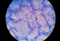 Infección del parásito del tejido de Microfilaria al ser humano fotos de archivo libres de regalías Infección del parásito del tejido de Microfilaria al ser humano fotos de archivo libres de regalías