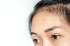 Inflammation d'acné sur le visage des jeunes femmes photographie stock libre de droits Inflammation d'acné sur le visage des jeunes femmes photographie stock libre de droits