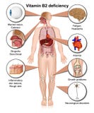 Infographic, τρισδιάστατη ιατρική απεικόνιση ανεπάρκειας βιταμινών B2 στο άσπρο υπόβαθρο διανυσματική απεικόνιση Infographic, τρισδιάστατη ιατρική απεικόνιση ανεπάρκειας βιταμινών B2 στο άσπρο υπόβαθρο διανυσματική απεικόνιση