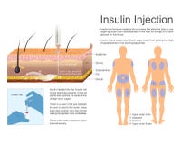 Insulin Injection. Vector, Illustration Design. vector illustration Insulin Injection. Vector, Illustration Design. vector illustration