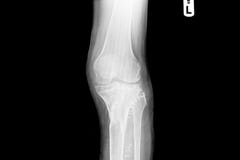 Internal of left leg fixed with plate and screws royalty free stock image Internal of left leg fixed with plate and screws royalty free stock image