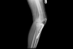Internal of left leg fixed with plate and screws stock image Internal of left leg fixed with plate and screws stock image