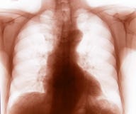 Inverted Chest X-ray Stock Photo