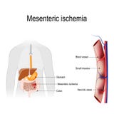 Ischemia mesenterica illustrazione di stock Ischemia mesenterica illustrazione di stock