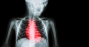 Ischemic Heart Disease , Myocardial Infarction ( MI ) ( Film x-ray body of human with heart disease and blank area at right side ) stock photography Ischemic Heart Disease , Myocardial Infarction ( MI ) ( Film x-ray body of human with heart disease and blank area at right side ) stock photography