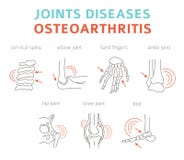 Joint les maladies Arthrite, symptômes d'ostéoarthrite, traitement i illustration libre de droits Joint les maladies Arthrite, symptômes d'ostéoarthrite, traitement i illustration libre de droits