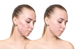 Jovem mulher antes e depois do tratamento da acne imagem de stock royalty free Jovem mulher antes e depois do tratamento da acne imagem de stock royalty free