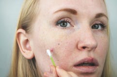 Jovem mulher com acne Aplicando a pomada à espinha Beleza, conceito do estilo de vida dos cuidados com a pele imagem de stock Jovem mulher com acne Aplicando a pomada à espinha Beleza, conceito do estilo de vida dos cuidados com a pele imagem de stock