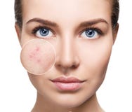 Jovem mulher com pele da acne no círculo do zumbido foto de stock Jovem mulher com pele da acne no círculo do zumbido foto de stock