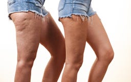 Jämförelse av ben med och utan cellulite royaltyfria bilder Jämförelse av ben med och utan cellulite royaltyfria bilder
