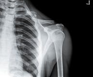 Klatka piersiowa X Ray z łamającym clavicle obrazy stock Klatka piersiowa X Ray z łamającym clavicle obrazy stock