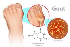 La gota es una forma de artritis inflamatoria ilustración del vector La gota es una forma de artritis inflamatoria ilustración del vector
