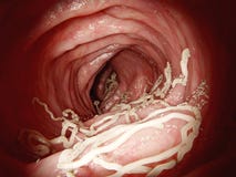 Large roundworm in human intestines