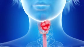 Larynx cancer stock video. Video of medical, disease - 140231021 Larynx cancer stock video. Video of medical, disease - 140231021