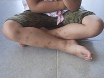 Las mordeduras de mosquito las piernas imágenes de archivo libres de regalías Las mordeduras de mosquito las piernas imágenes de archivo libres de regalías