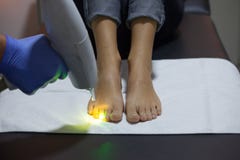Laser nail fungus treatment stock photo Laser nail fungus treatment stock photo