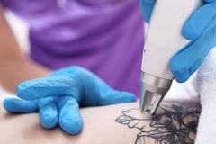 Laser tattoo removal in cosmetic surgery.