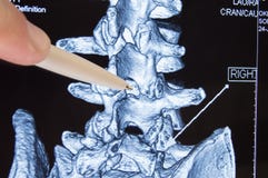 Lekarek przedstawienia na CT MRI obrazów cyfrowych miejscu w kręgosłupie który jest procedurą epidural anestezja lub dordzenioweg fotografia royalty free Lekarek przedstawienia na CT MRI obrazów cyfrowych miejscu w kręgosłupie który jest procedurą epidural anestezja lub dordzenioweg fotografia royalty free