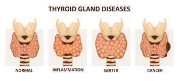 Les maladies de glande thyroïde illustration stock Les maladies de glande thyroïde illustration stock