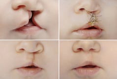 Lip and palate cleft before and after surgery