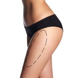 Liposuction lines on a woman`s body. body of a beautiful wo stock images Liposuction lines on a woman`s body. body of a beautiful wo stock images
