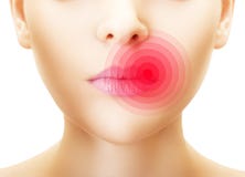 Lippen door herpes worden getroffen die. stock foto's Lippen door herpes worden getroffen die. stock foto's