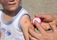 Little girl with mosquito bite on arm