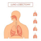 Lobectomy do pulmão ilustração stock Lobectomy do pulmão ilustração stock