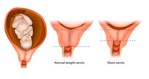 Longueur normale et cervix court illustration stock Longueur normale et cervix court illustration stock