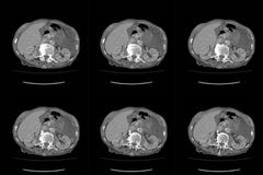 Mage för CT för beräknad tomography hel i axiellt Del tjugo arkivfoto Mage för CT för beräknad tomography hel i axiellt Del tjugo arkivfoto