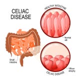 Malattia celiaca piccoli intestinale con i villi normali e villous royalty illustrazione gratis Malattia celiaca piccoli intestinale con i villi normali e villous royalty illustrazione gratis