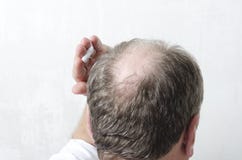 Mann, der spezielle Creme f?r Haarwachstum auftr?gt Sch?nheitsbegriffverfahren f?r Haarpflege lizenzfreie stockfotos Mann, der spezielle Creme f?r Haarwachstum auftr?gt Sch?nheitsbegriffverfahren f?r Haarpflege lizenzfreie stockfotos