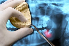 Mano del dentista con mal di denti ortodontico dei denti del giudizio di manifestazione dello strumento fotografia stock Mano del dentista con mal di denti ortodontico dei denti del giudizio di manifestazione dello strumento fotografia stock