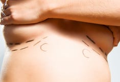 Marks under breasts for cosmetic surgery