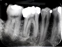Materiale da otturazione di amalgama dentario del film dei raggi x fotografie stock libere da diritti Materiale da otturazione di amalgama dentario del film dei raggi x fotografie stock libere da diritti