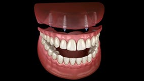 Maxillary Prosthesis All on 4 System Supported by Implants. Medically  Accurate 3D Animation of Human Teeth and Dentures Concept Stock Video -  Video of prosthesis, boer: 180777565