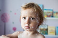 Mała dziewczynka z chickenpox, antyseptyczna śmietanka stosował rasa zdjęcie stock Mała dziewczynka z chickenpox, antyseptyczna śmietanka stosował rasa zdjęcie stock
