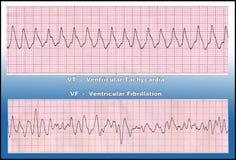 Medicina - aritmia mortale del cuore - VT & VF Fotografia Stock Libera da Diritti Medicina - aritmia mortale del cuore - VT & VF Fotografia Stock Libera da Diritti