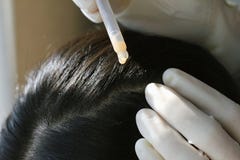 Medique a doação de um tratamento no cabelo do ` s e no escalpe pacientes, fim acima do tiro da desordem do escalpe do exame do d imagens de stock Medique a doação de um tratamento no cabelo do ` s e no escalpe pacientes, fim acima do tiro da desordem do escalpe do exame do d imagens de stock