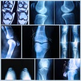 Medizinische Prüfung des Knies: Röntgenstrahl und MRI-Scan stockfotografie Medizinische Prüfung des Knies: Röntgenstrahl und MRI-Scan stockfotografie
