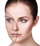 Meisje met acne before and after behandeling royalty-vrije stock foto Meisje met acne before and after behandeling royalty-vrije stock foto