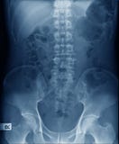 Menschlicher Dorn der Röntgenbildspondylose und Becken- stockbilder Menschlicher Dorn der Röntgenbildspondylose und Becken- stockbilder