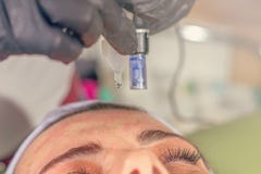 Mesotherapy Behandlung der Nadel auf einem Frauengesicht Stockfoto Mesotherapy Behandlung der Nadel auf einem Frauengesicht Stockfoto