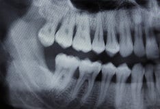 Metade esquerda do raio X dental imagem de stock royalty free Metade esquerda do raio X dental imagem de stock royalty free