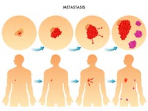 metastasis vektor illustrationer metastasis vektor illustrationer