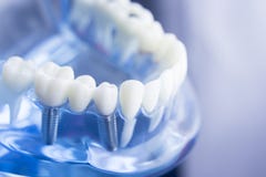Modèle dentaire d'art dentaire de dents photo stock Modèle dentaire d'art dentaire de dents photo stock