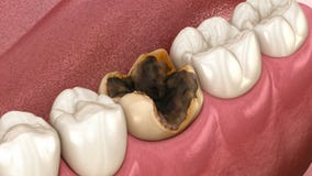Molar teeth damaged by caries. Medically accurate tooth animation