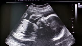 Monitor with medical ultrasound scan of human baby. 4K UltraHD video