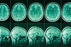 MRI av huvudet och hjärnan av en person arkivbild MRI av huvudet och hjärnan av en person arkivbild